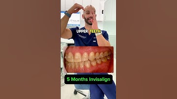 Can Invisalign fix my bite or do I need braces?