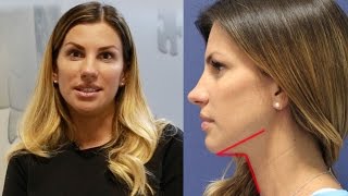 Подтяжка овала лица. Рассасывающиеся нити Подтяжка овала лица. Рассасывающиеся нити