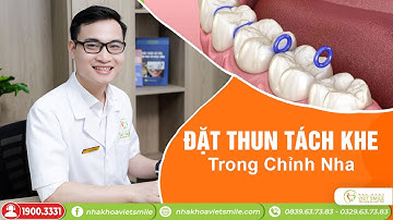 Đặt chun tách khe có đau không?để làm gì? thời gian bao lâu?
