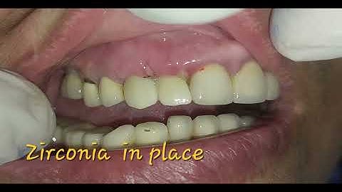 Situational implantology:socket shield and  immediate loading  using Quickdent implants 