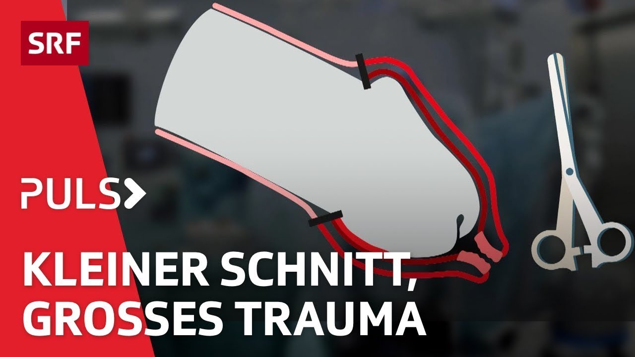 Vorhautbeschneidung – Umstrittener Eingriff in körperliche