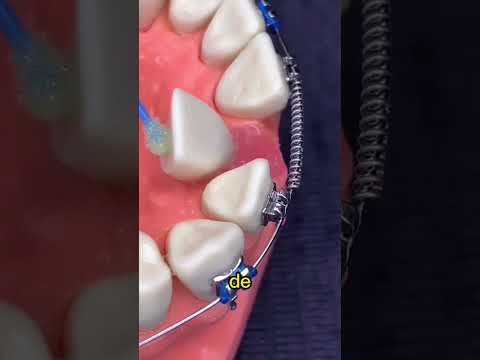 Video: 4 formas de enderezar los dientes