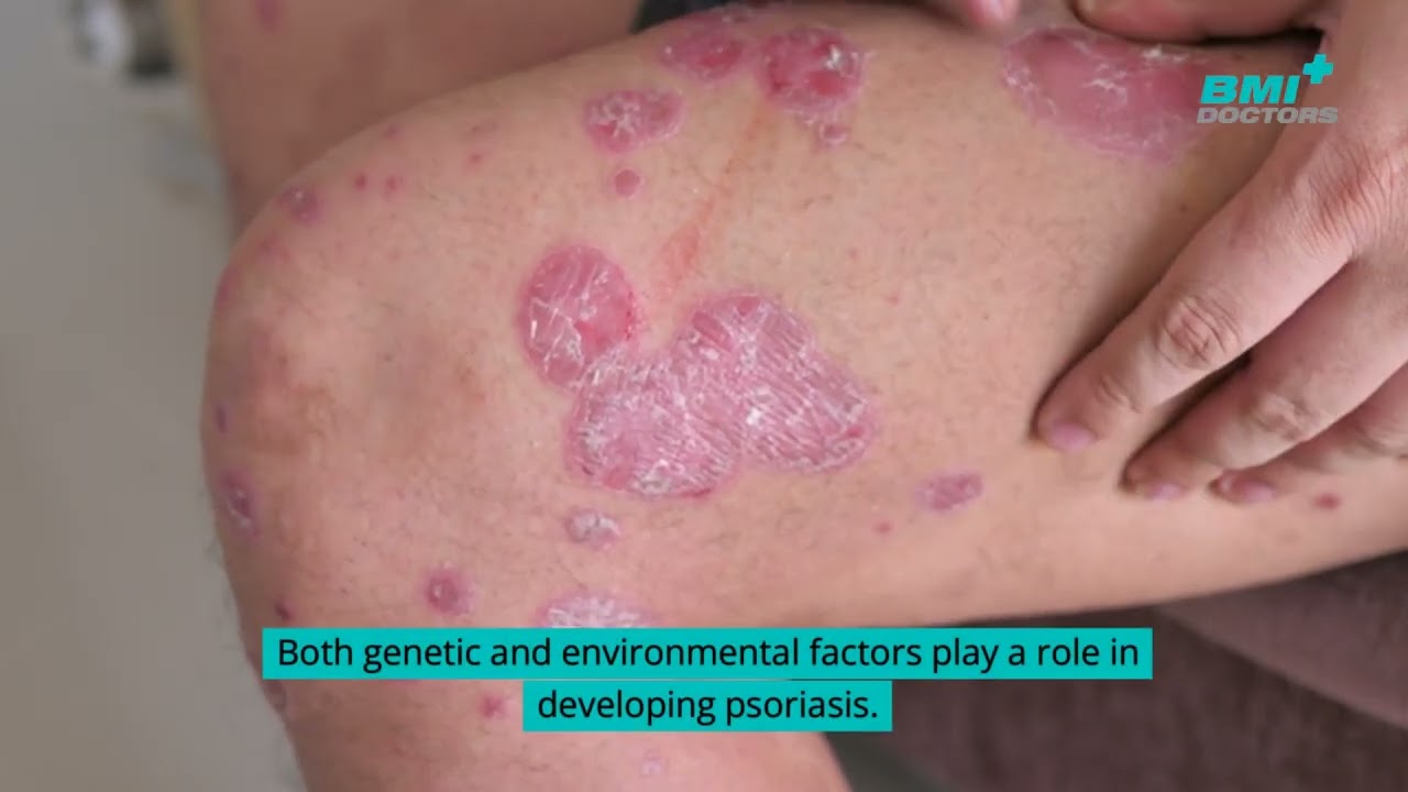 The Link Between Psoriasis and Semaglutide: A Detailed Overview for Better Management - YouTube The Link Between Psoriasis and Semaglutide: A Detailed Overview for Better Management - YouTube