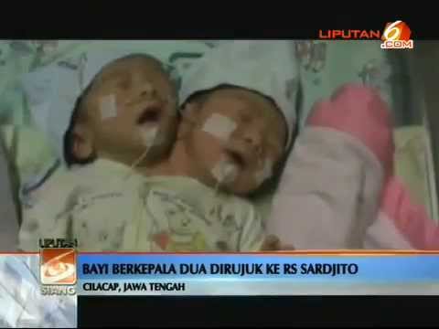 Video: Anak Berkepala Dua Lahir Di Indonesia - Pandangan Alternatif