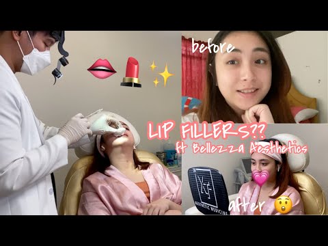 vlog # 16: I FINALLY DECIDED TO GET LIP FILLERS!! Ft  Bellezza Aesthetics