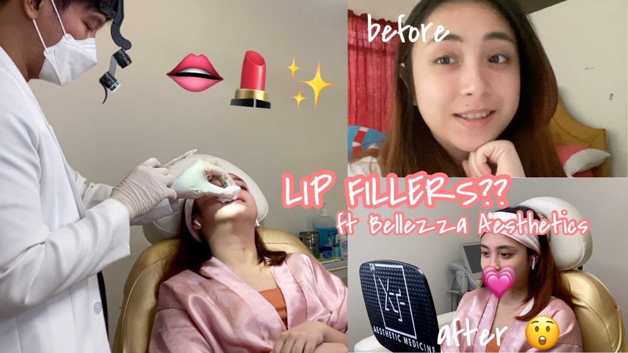 vlog # 16: I FINALLY DECIDED TO GET LIP FILLERS!! Ft  Bellezza Aesthetics