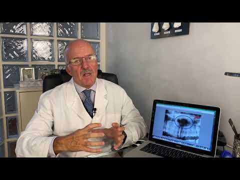 Video: Cisti Del Dotto Poliaglossale: Chirurgia, Trattamento E Sintomi