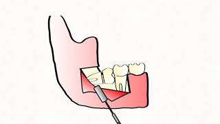 水平智齒拔除動畫