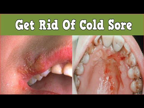 Get Rid Of Cold Sore, What Is A Cold Sore, Cold Sores On Tongue, Lip Cold Sore, Cold Sore Tongue