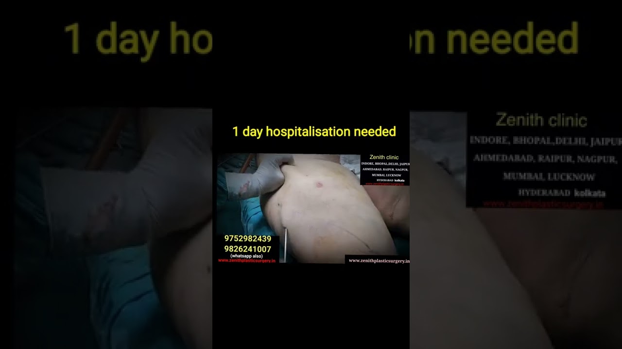 liposuction before and after | live surgery 80kg patient