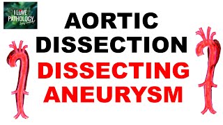 Aortic Dissection |Dissecting Aneurysm |etiopathogenesis| Morphology |clinical features | Treatment