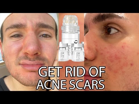 Revolutionary Acne Scar Treatment: Micro Infusion VS Microneedling AD