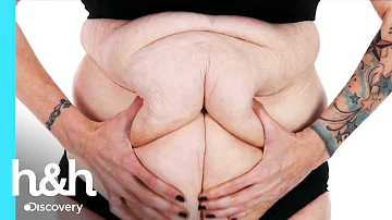 ¿Qué es una abdominoplastia 360?