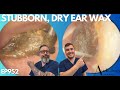 SUPER STUBBORN, DRY EAR WAX REMOVAL - EP952