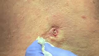 Cyst gross disgusting slow extraction crumble  DPOW