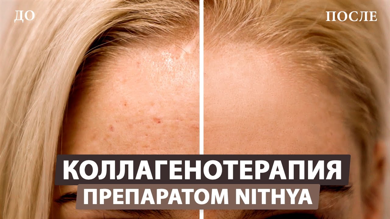 Введение коллаген. Коллагенотерапия лица. Nithya коллаген. Коллаген инъекции для лица. Уколы коллагена в лицо до и после.