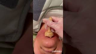 POV: Double Chin & Jawline Sculpting