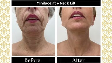 Liftingul Gatului / Liposuctie gusa ➤ Dr. Levy (poze inainte si dupa operatie Bucuresti & Timisoara)