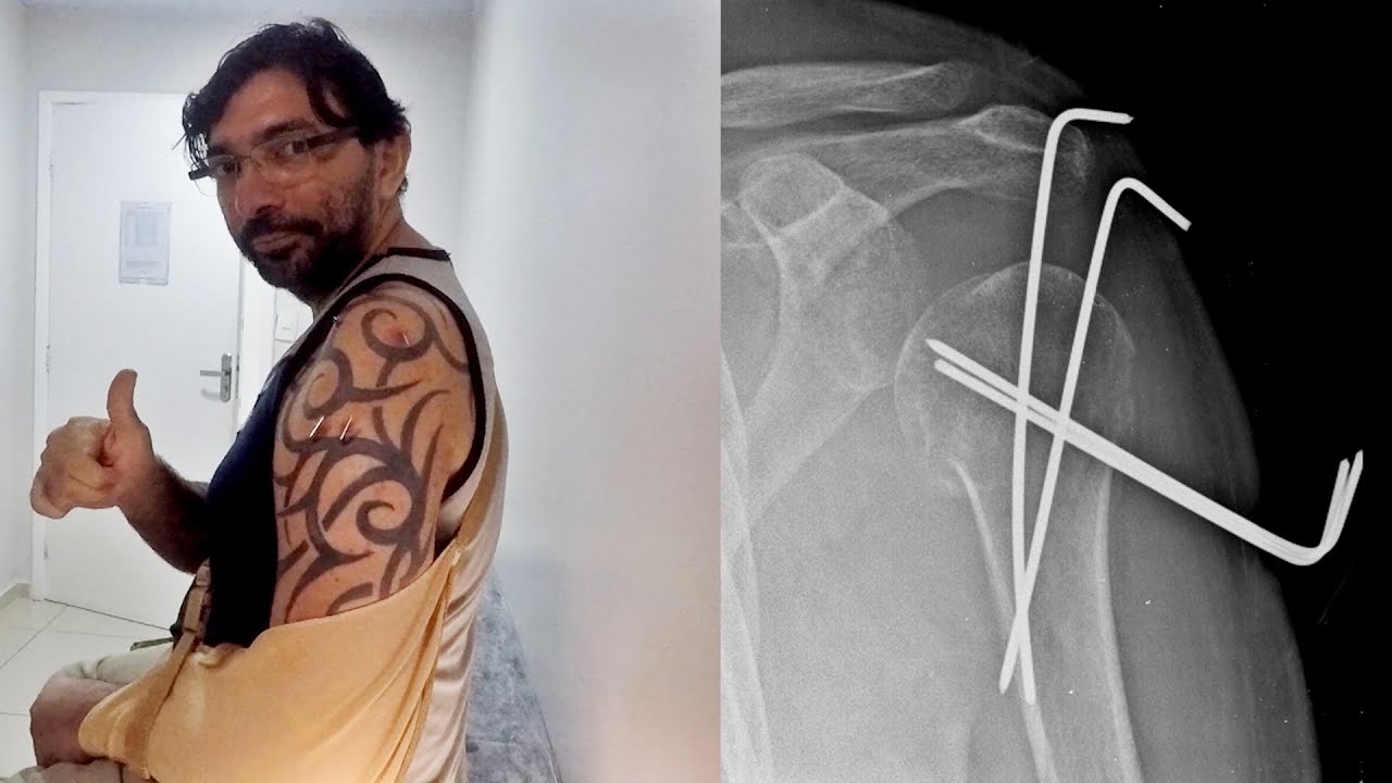 Retirada dos Fios de Kirschner ( 4 fios ) fratura do Umero Proximal YouTube Retirada dos Fios de Kirschner ( 4 fios ) fratura do Umero Proximal YouTube