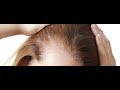 L'alopecia areata