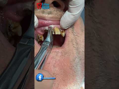 Video: Təsirlənmiş ağıl dişlərini çıxarmalıyam?