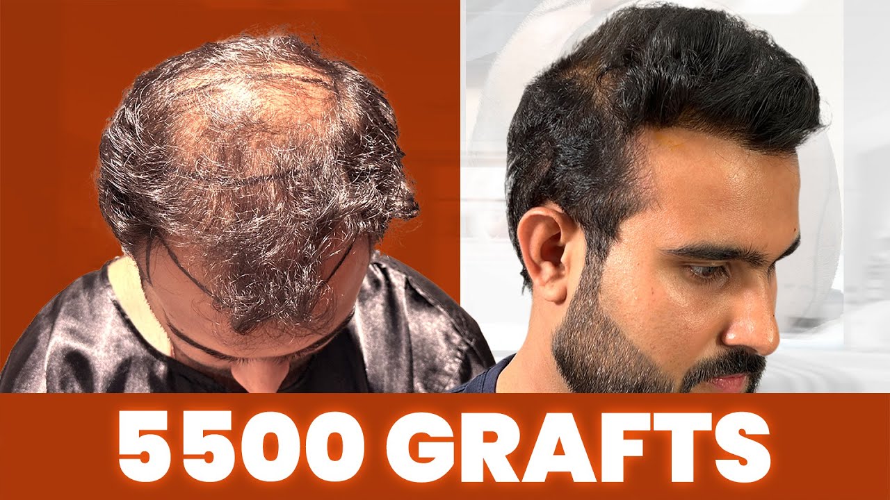 Hair Transplant in Hyderabad | Best Results \u0026 Cost of Hair Transplant in Hyderabad