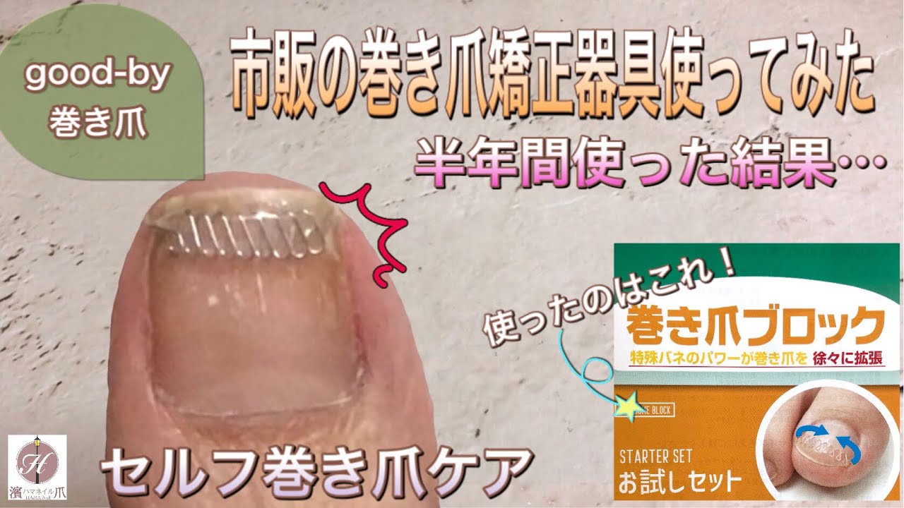 セルフ巻き爪ケア 痛い巻き爪グッバイ 市販の巻き爪矯正器具を半年使った結果 Youtube