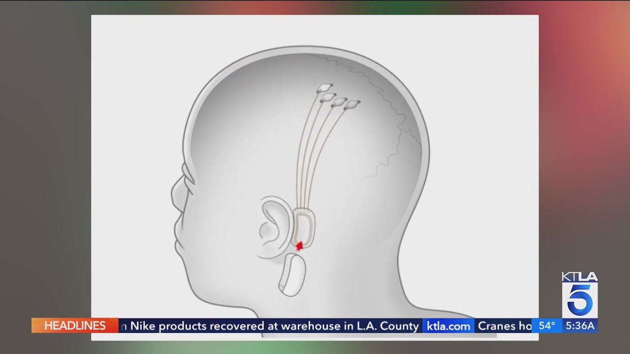 Elon Musk Says Neuralink Has Implanted Brain Chip in Human