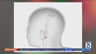 Musk’s Neuralink implants brain chip in 1st human