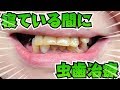[無痛麻酔 ]寝ている間に虫歯治療 Tooth Decay 1day treatment[dentistry](睡眠中進行的蛀牙治療)[歯医者]