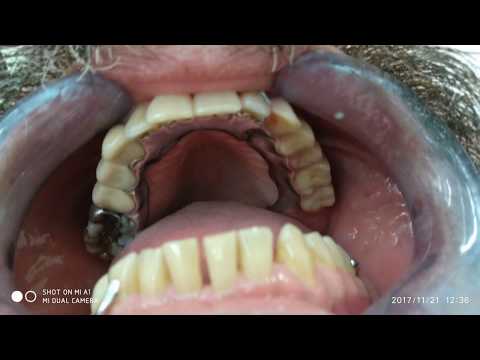 Βίντεο: Ποιες είναι οι καλύτερες και πιο άνετες οδοντοστοιχίες