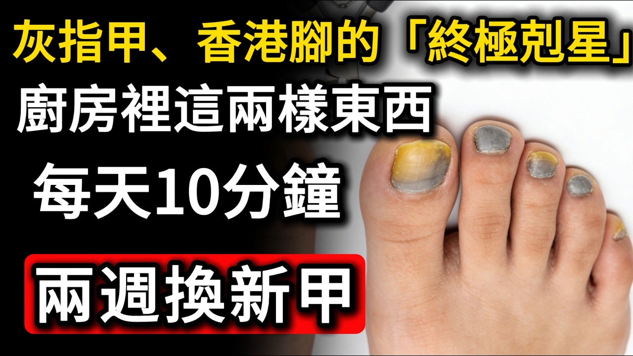 灰指甲、香港腳的「終極剋星」！廚房裡這兩樣東西，每天10分鐘，兩週換新甲！#灰指甲 #香港腳 #腳臭 #居家保健 #孫志成 #小蘇打粉 #粗鹽 #健康生活 #皮膚修復 #腳部護理 #抗黴菌