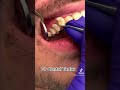Dental cleaning scaling dentist tiktok viral trending shorts youtubeshorts youtube