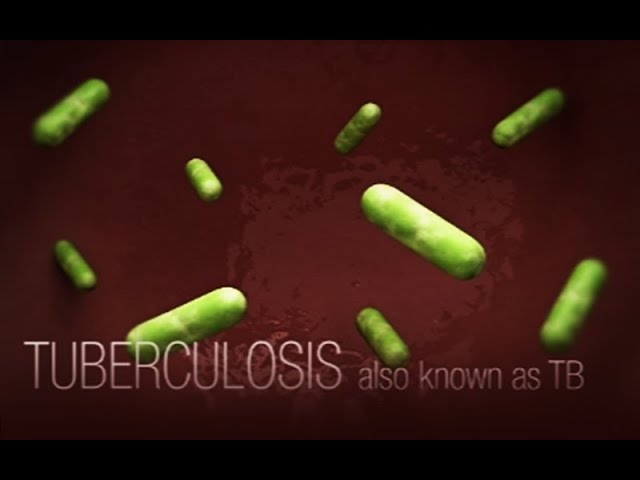 CDC Tuberculosis (TB) Transmission and Pathogenesis Video class=