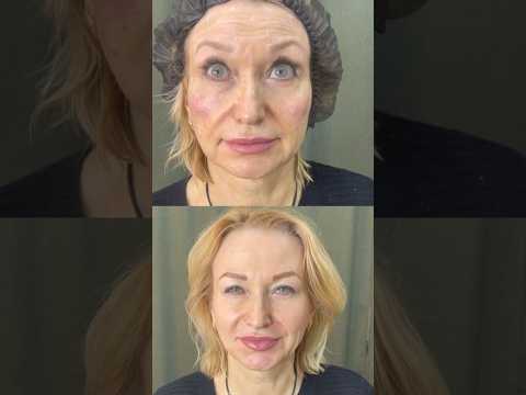 Ботокс :лоб,межбровье и подняли кончик носа #косметологростов #контурнаяпластика #фулфейс #ботокс