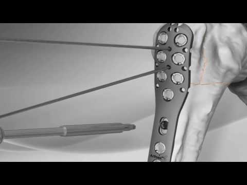 Videó: Hogyan lehet hasítani a humusz törést: 8 lépés (képekkel)
