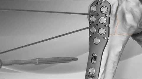 Proximal Humerus Fracture Repair with Arthrex® SuturePlate™