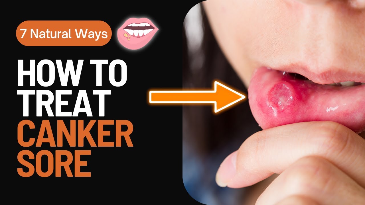 How to Treat Canker Sore / Gamot Sa Singaw Or Canker Sore ( Home remedies for Canker Sore) YouTube