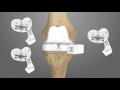 iTotal CR Total Knee Replacement Surgical Technique Animation | Conformis