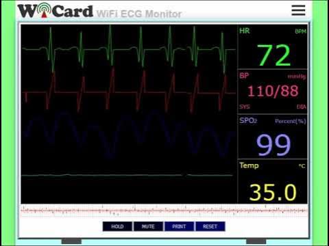 WiFi ECG Monitor with ESP8266/ESP32 and MAX30100 - YouTube image.