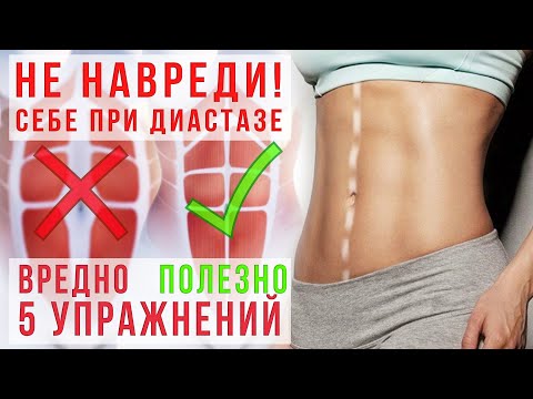 Упражнения при диастазе.ЧТО можно и  ЧТО нельзя.Делай худой живот с умом.