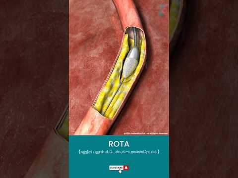 சுழலும் பலூன் ஸ்டென்டிங் என்றால் என்ன ↪ 3D Medical Animation #Shorts #ROTA #Angioplasty