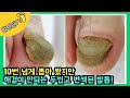 [ENG SUB] 10번 넘게 뽑아 봤지만, 해결이 안되는 두껍고 변색된 발톱ㅠㅠㅠ