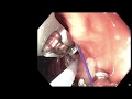 Endoscopic Sleeve Gastroplasty (ESG) in less than 3 minutes!