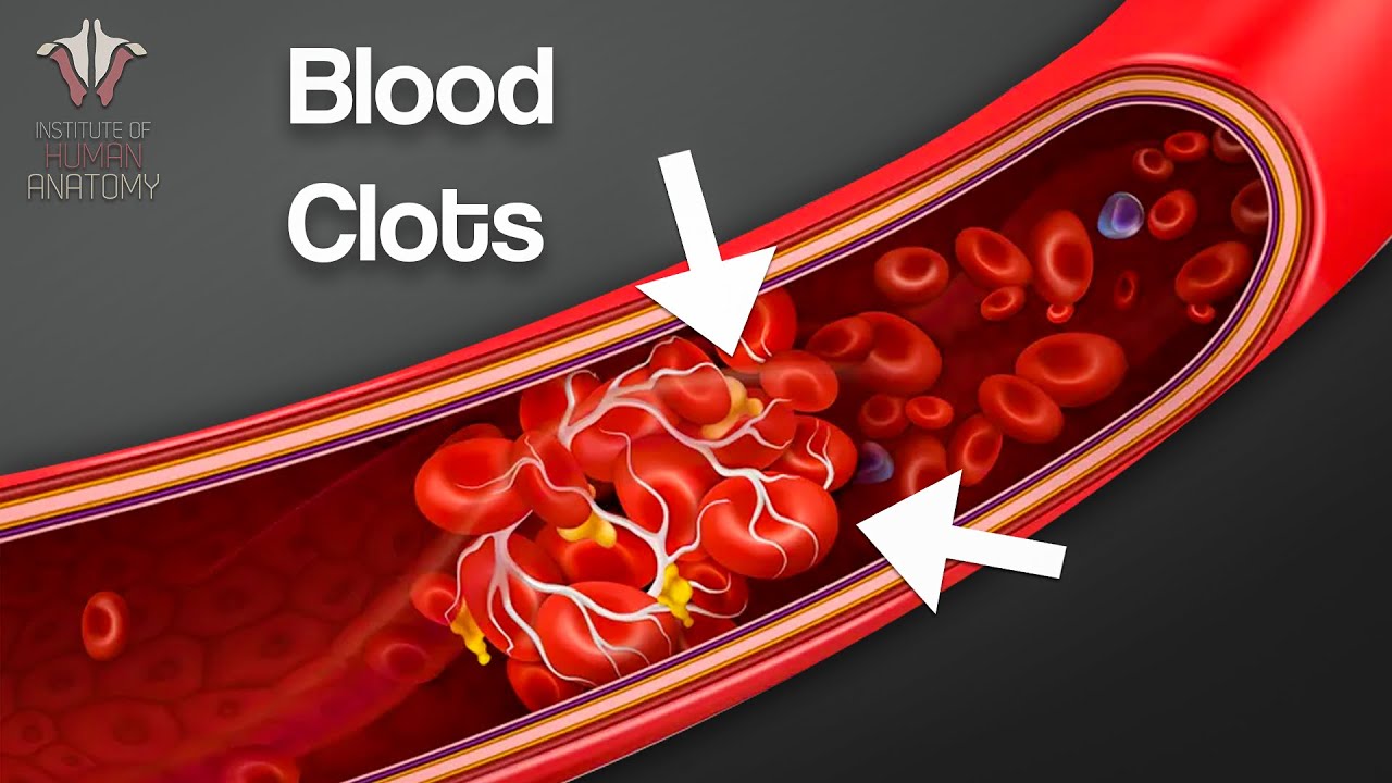 What You NEED to Know About Blood Clots 