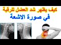كيف يظهر شد العضل بالرقبه في صوره الاشعه