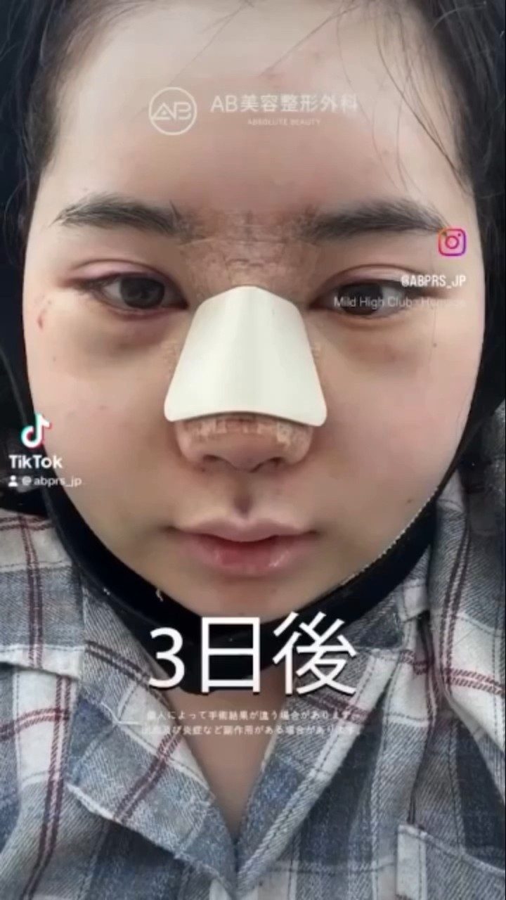 [韓国整形] 顔面輪郭整形 + 頬骨 + エラ + 鼻の再手術 #ab美容外科