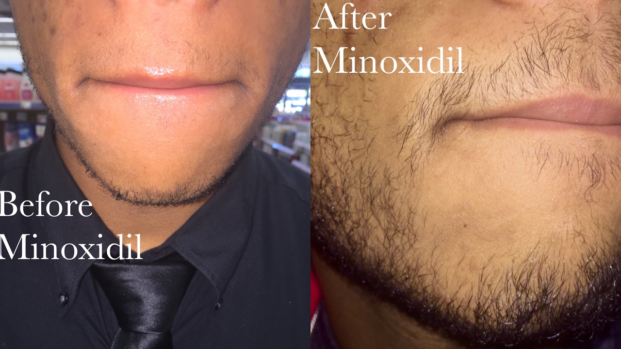 does foam or liquid minoxidil work better