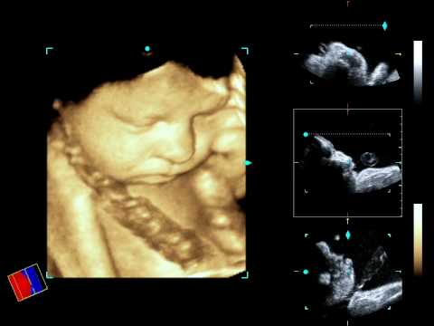 Video: Vidíte implantáciu na ultrazvuku?