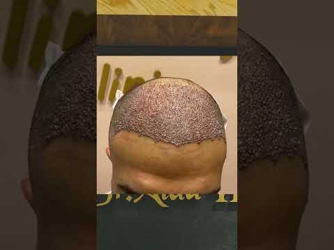 نصائح لازم تتبعها بعد عملية زراعة الشعر
